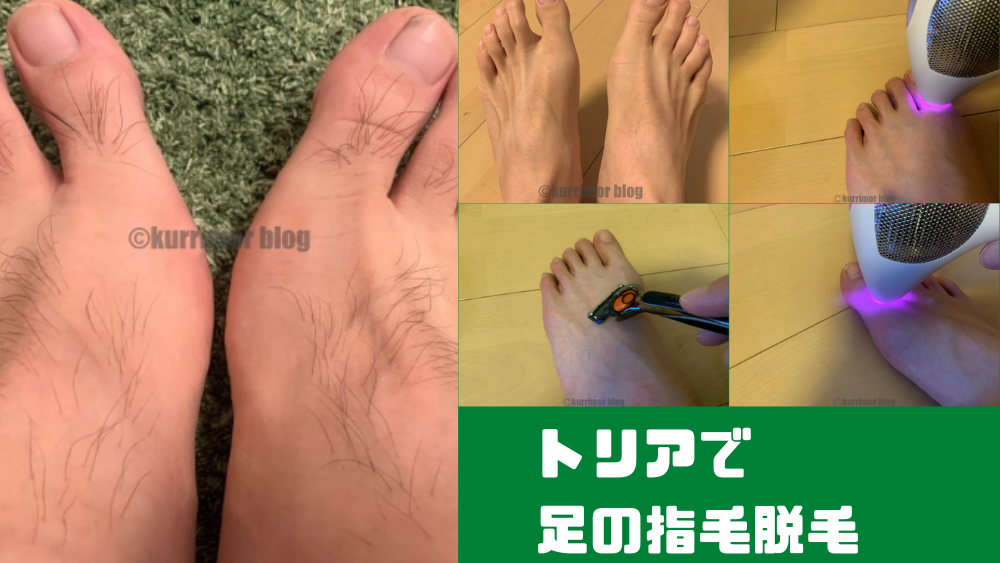 【トリアを2年！】男の足の甲、足の指毛の脱毛ブログ